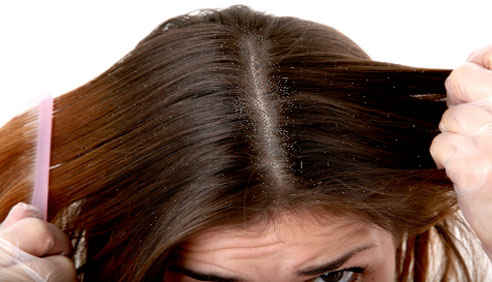 dandruff-remedies